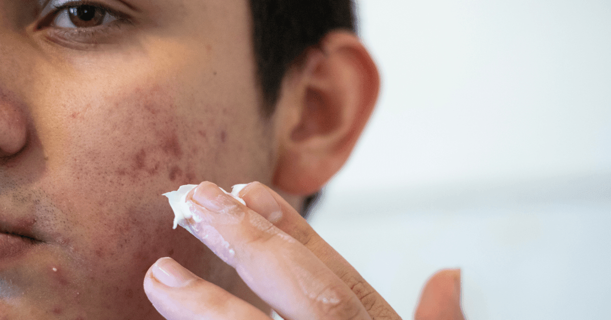 How to Get Rid of Acne for Men – Your Skincare Guide - Ark & Ocean